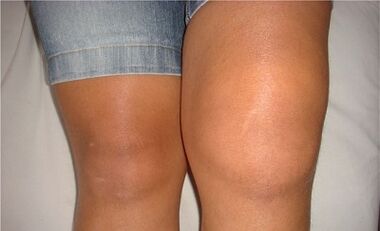 Les causes de l'arthrose de l'articulation du genou